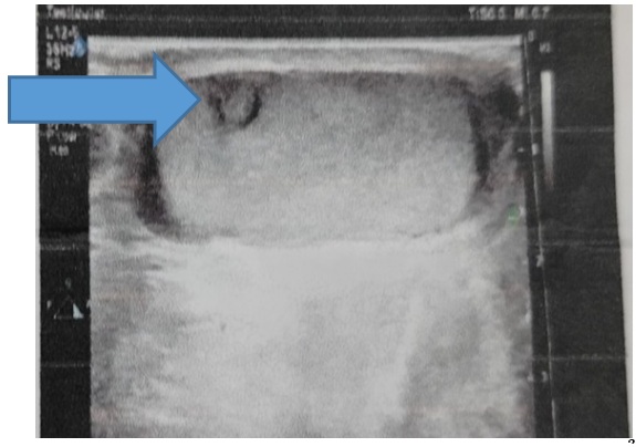 Phẫu thuật thành công lấy dị vật kim loại xuyên vào tinh hoàn do tai nạn lao động