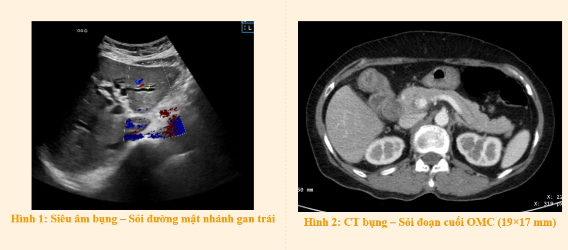 Điều trị sỏi ống mật chủ bằng phẫu thuật nội soi và tán sỏi Laser qua đường hầm Kehr – Phương pháp hiện đại, ít đau, hồi phục nhanh